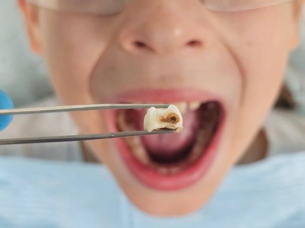Best Emergency Dentist for Lost Fillings or Crowns in Opp, AL